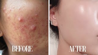 Get CLEAR SKIN subliminal  Get rid of acne in 10 minutes [upl. by Codee]