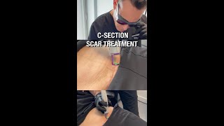 How to do Scar Massage [upl. by Theron661]