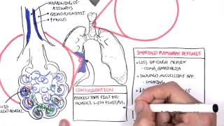 PART I  Pneumonia Overview Lobar and Bronchopneumonia [upl. by Lamaaj]