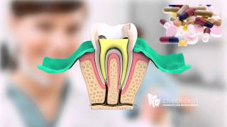 What is a Root Canal Treatment [upl. by Nnaed]