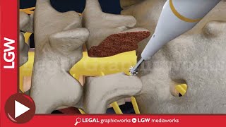 L5S1 Lumbar Discectomy and Fusion Surgery 3D animation [upl. by Nal]