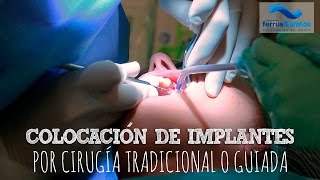 Colocación de implantes dentales [upl. by Ahsieki]