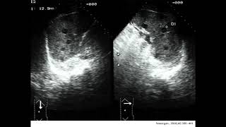 TRAUMATISMO ESPLÉNICO HEMATOMA SUBCAPSULAR HEMATOMA PERICAPSULAR DE BAZO [upl. by Breena]