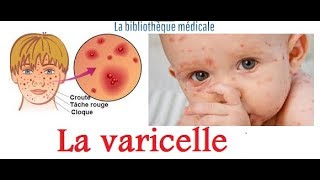 La varicellediagnosticcliniquetraitement et Prévention [upl. by Nyrahs]