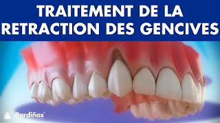 Récession Gingivale – Traitement de la retraction des gencives © [upl. by Corbet486]