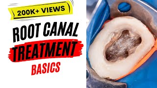 Root Canal Treatment Basics  StepbyStep [upl. by Acsisnarf]