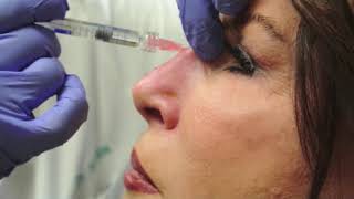 Nonsurgical Rhinoplasty [upl. by Rossner]