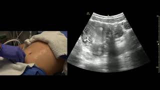 Transabdominal Pelvis Ultrasound Scanning Techniques [upl. by Condon]