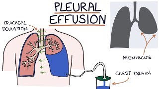 Understanding Pleural Effusions [upl. by Vevay]