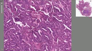 Endometrial Adenocarcinoma  Histopathology [upl. by Nonnahsal]