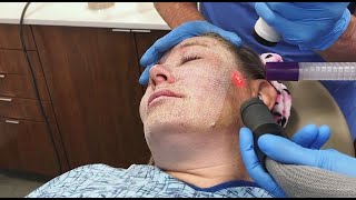 Full Face Fractional CO2 Laser Resurfacing for Wrinkles and Skin Tightening [upl. by Nelie]