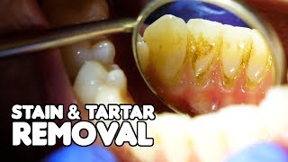 Dental Cleaning EXPLAINED  Stain amp Tartar Removal [upl. by Komarek342]