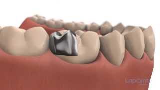 Inlays and onlays  Lapointe dental centres [upl. by Vitus922]