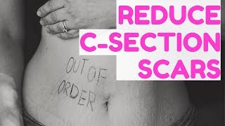 C Section Scar Recovery [upl. by Mazel]