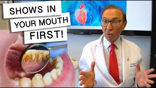 5 Diseases That Show Signs In Your Mouth [upl. by Ahsert]