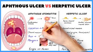 Aphthous ulcer Aphthous stomatitis vs Herpetic ulcer  How to diagnose [upl. by Enrique218]