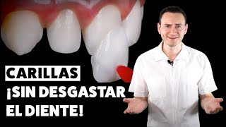 Carillas dentales ¡SIN DESGASTE Una excelente opción  CASO REAL [upl. by Tanhya]