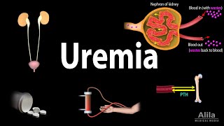 Uremia Pathophysiology Symptoms Diagnosis and Treatment Animation [upl. by Imoyn]