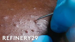 I Got Professional Blackhead Extractions  Macro Beauty  Refinery29 [upl. by Hannej]