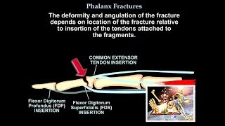 Phalanx Fractures  Everything You Need To Know  Dr Nabil Ebraheim [upl. by Auqinat]