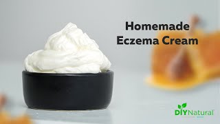 DIY Eczema Cream A Homemade Natural Solution That Works [upl. by Elokin639]