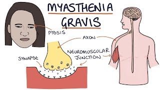 Myasthenia Gravis [upl. by Nnaillek253]