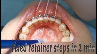 Fixed orthodontic retainer steps [upl. by Ystap]