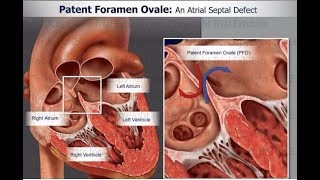 Patent foramen ovale PFO Part II [upl. by Hgeilhsa]