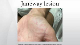 Janeway lesion [upl. by Erena]