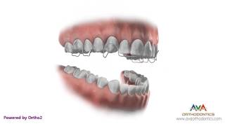 Orthodontic Retainer  Hawley  Instruction and Care [upl. by Voletta]