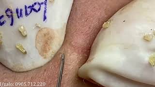 BECAUSE OF ACNE THAT CAME Loan Nguyen spa 67  Loan Nguyen [upl. by Ayotnom122]