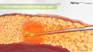 Laser Liposuction [upl. by Kehoe905]