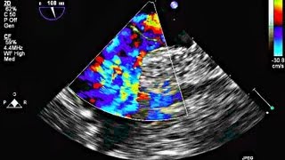 Interatrial Septal Aneurysm and Patent Foramen Ovale  Echocardiography [upl. by Jerusalem]