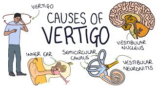 Understanding the Causes of Vertigo [upl. by Gothard]