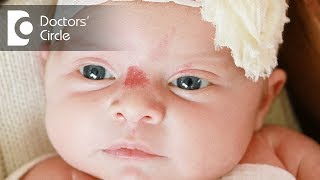 What are the treatment options of Hemangioma  Dr Sachith Abraham [upl. by Carlton]