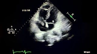 Parodoxical Embolus Across a Patent Foramen Ovale [upl. by Ocicnarf309]