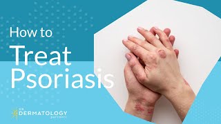 Psoriasis Treatment  Explained by Dermatologist [upl. by Naehs]