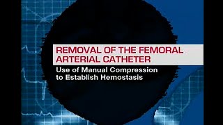 How to pull an arterial femoral sheath [upl. by Sylera]