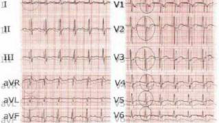 elettrocardiogrammasecondapartewmv [upl. by Robet]