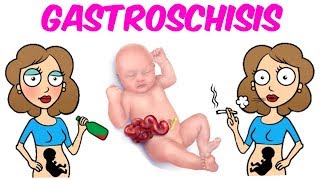 Gastroschisis [upl. by Daley]