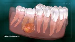 Dental Abcess  Why Root Canal Treatment Is Needed [upl. by Hales]