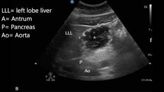 Gastric ultrasound for preoperative assessment [upl. by Haymes]