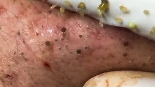 Blackheads [upl. by Jolee336]