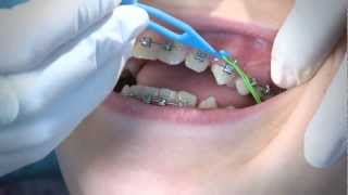 How to Wear Orthodontic Elastic Bands [upl. by Eberto]