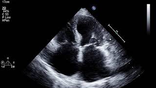 Patient with a Patent Foramen Ovale [upl. by Saiff]