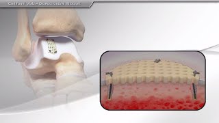 Meniscus Allograft Transplant  CONMED Animation [upl. by Enois]