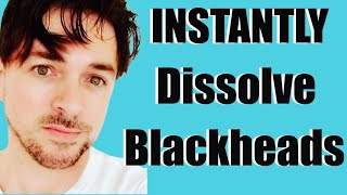 INSTANT Blackhead Removal  Removing Blackheads From Nose  Face  CHRIS GIBSON [upl. by Daisy]