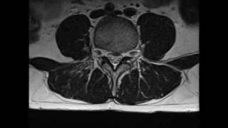 MRI of lumbar spine L4 L5 S1 disc bulge [upl. by Loos]