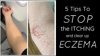 HEALING ECZEMA  5 Things I Do Each Day To STOP THE ITCH [upl. by Happ]