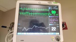 Tips for GE Bedside Monitors [upl. by Kroll175]